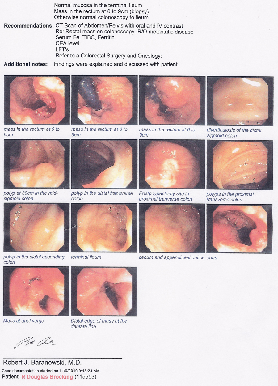 ncrf doug colon cancer mass size